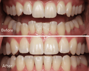 Dental Arts on Essex Aligner Therapy Before and After