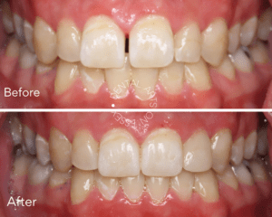 Dental Arts on Essex Aligner Therapy Before and After Patient